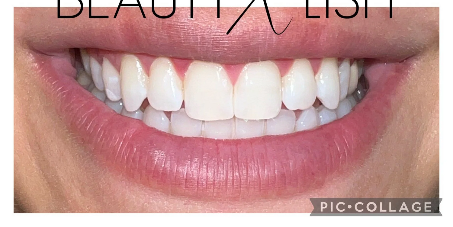 Before and after comparison of teeth with dental straighteners, featuring the 'Beautylish' brand.